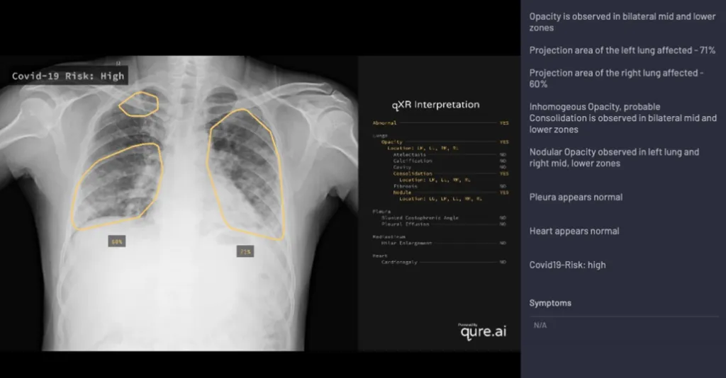 AI-Based Diagnosis of a Chest X-Ray Scan